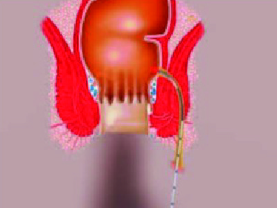 fistule anale 1