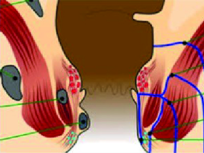fistule anale 3jpg
