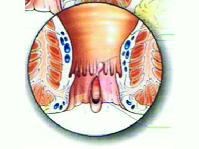 fissure anale 1