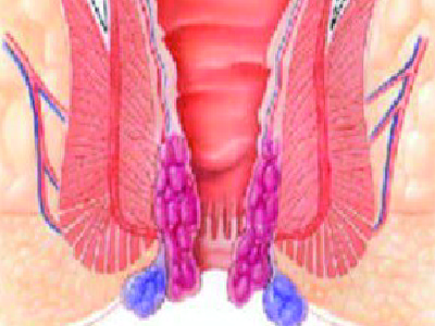 hemorroide 1