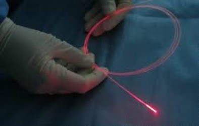 laser
