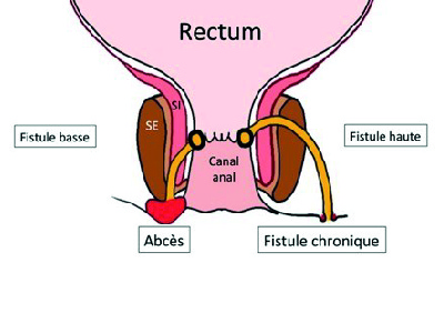 fistule anale 2