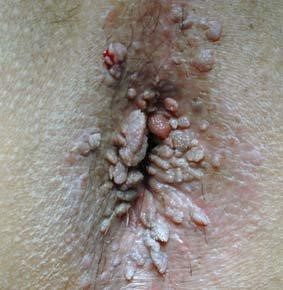 condylome