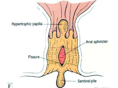 fissure anale 2