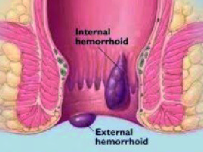 hemorroide 2